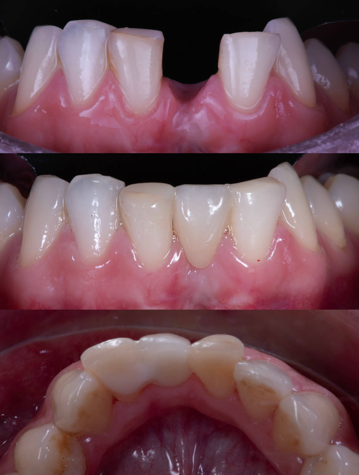 Le bridge collé cantilever - SCP Nadal Chirurgiens Dentistes