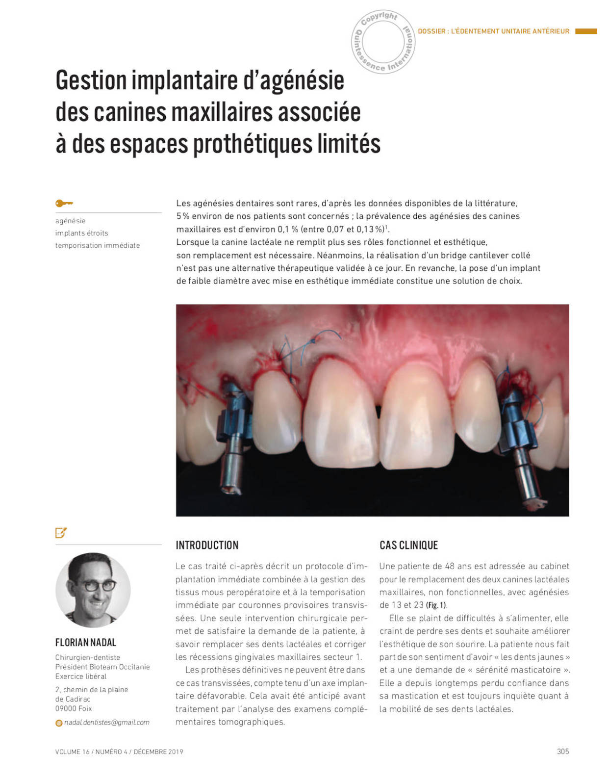 Le bridge collé cantilever - SCP Nadal Chirurgiens Dentistes