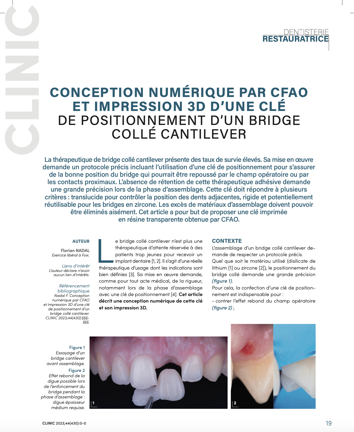 Le bridge collé cantilever - SCP Nadal Chirurgiens Dentistes